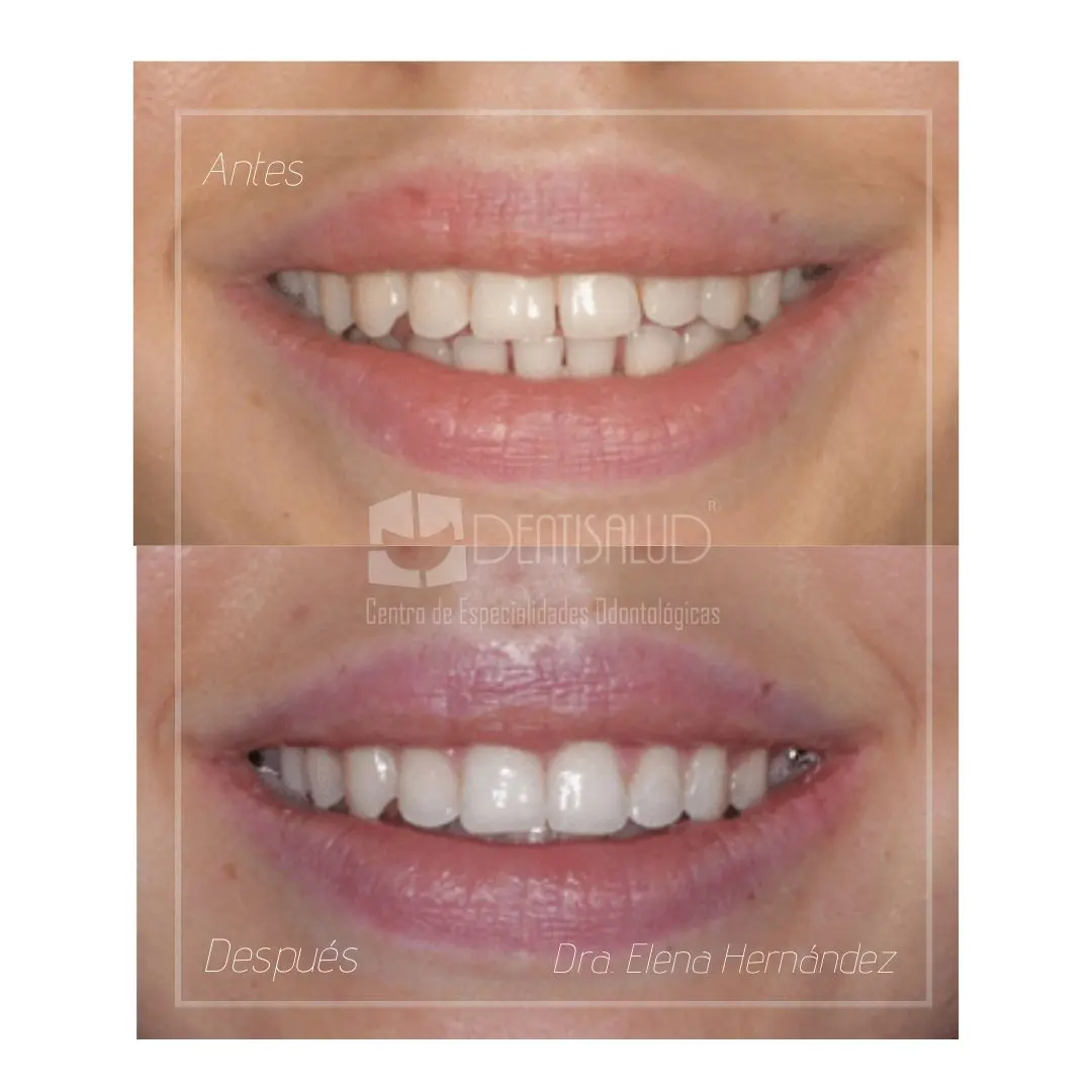 Sonrisa tras tratamiento Invisalign en Clínica Dentisalud Boadilla