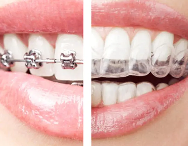 Comparativa de alineadores transparentes Invisalign Diamond Apex en Dentisalud Boadilla del Monte