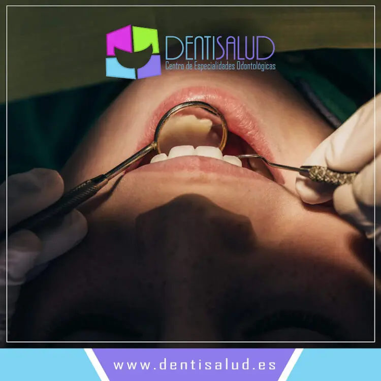 Ventajas de Invisalign First en niños