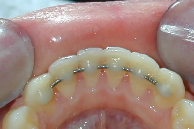 Retenedor fijo colocado tras un tratamiento de ortodoncia para mantener la posición de los dientes.